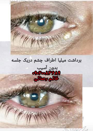 برداشتن خال عطاری