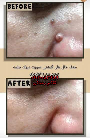 اسم قطره برداشتن خال | بهترین قطره گیاهی قوی برای خال صورت و بدن