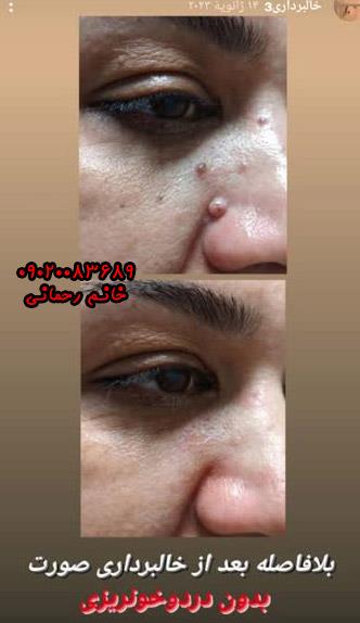 برداشتن خال با محلول | معرفی قویترین محلول گیاهی برای حذف خال بدون جراحی
