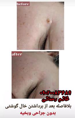 محلول برداشتن خال گوشتی