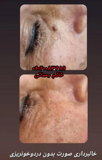 از بین بردن خال گوشتی با محلول