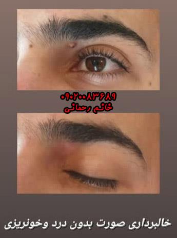 بهترین فصل برای برداشتن خال صورت | رازهای زمانبندی برای نتایج عالی