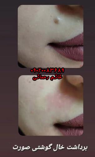 برداشتن خال با مواد گیاهی و محلول | راهکار طبیعی و موثر برای حذف خالهای پوستی