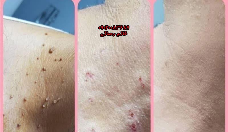 اسم قطره برداشتن خال | بهترین قطره گیاهی قوی برای خال صورت و بدن