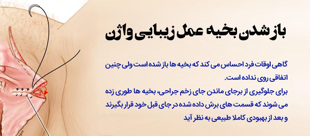علل، علائم و درمان باز شدن بخیه پرینورافی | پیشگیری از مشکلات بخیههای پرینورافی