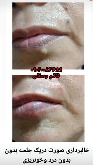 از بین بردن خالهای سطحی صورت با درمانهای طبیعی
