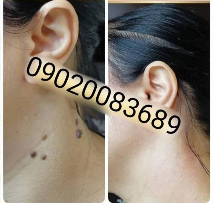 برداشتن خال گوشتی در خانه | راهنمای کامل و طبیعی حذف خال با محلول گیاهی