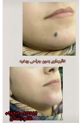 محلول از بین بردن خال صورت | راهنمای ورود به زیبایی طبیعی پوست