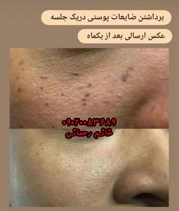محلول برداشتن کک ومک