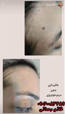 محلول برداشتن خال | راهنمای موثر و گیاهی برای حذف خال در خانه