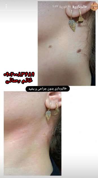 درمان خال صورت بدون جراحی و در خانه