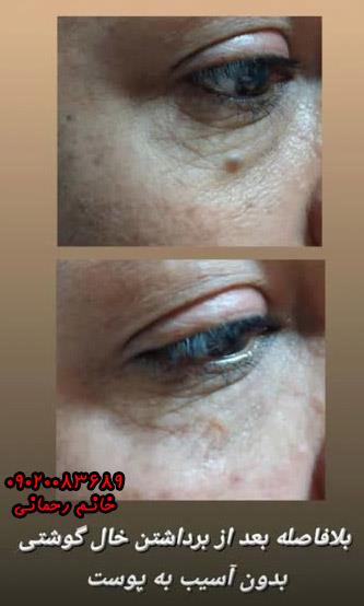 از بین بردن خال های سطحی صورت طب سنتی