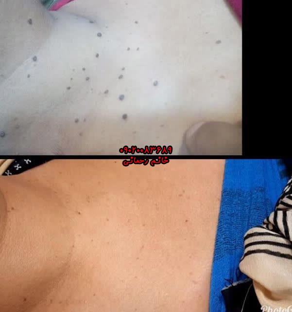 نحوه استفاده از قطره زگیل | آموزش گام‌به‌گام و مراقبت پس از آن