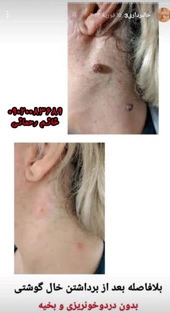 از بین بردن خال با داروهای گیاهی در خانه