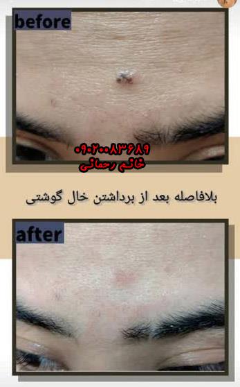 اسم قطره برداشتن خال سیاه | بهترین قطره طبیعی قوی برای حذف خال سیاه