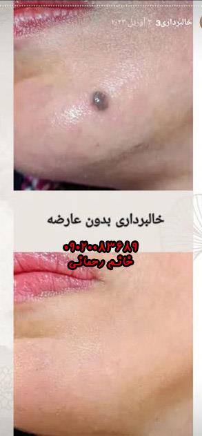 برداشتن خال عطاری | بهترین روش طبیعی و موثر حذف خالهای پوستی