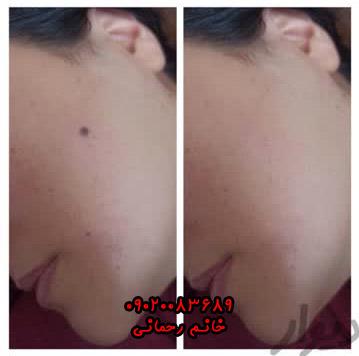 برداشتن خال با مواد گیاهی | روش طبیعی و بدون جراحی برای پاکسازی خال
