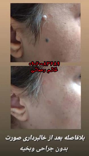 برداشتن خال با مواد گیاهی | روش طبیعی و بدون جراحی برای پاکسازی خال