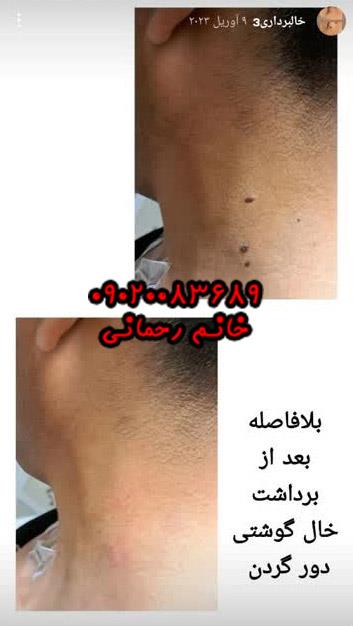 برداشتن خال گوشتی با محلول | راهکار طبیعی و موثر برای حذف خالهای پوستی