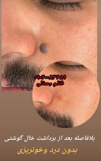 برداشتن خال گوشتی با محلول | راهکار طبیعی و موثر برای حذف خالهای پوستی