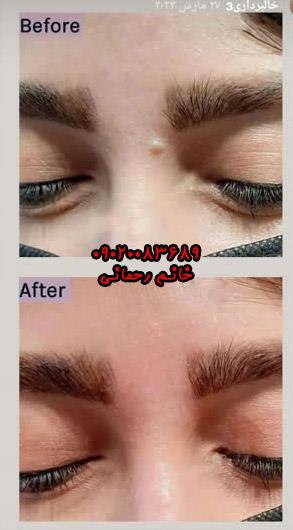 بهترین محلول برای رفع کک و مک | درمان گیاهی سریع و مؤثر کک و مک صورت
