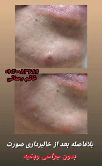 قویترین محلول ضد کک مک | بهترین راه درمان لکهای پوستی با فرمول گیاهی و طبیعی