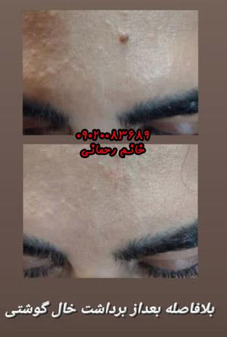 از بین بردن خالهای سطحی صورت طب سنتی | درمان سریع و طبیعی خالهای صورت با داروهای گیاهی