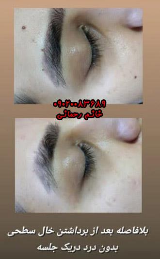 محلول درمان میخچه و زگیل | راهکار خانگی، سریع و بدون درد