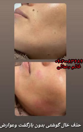 بهترین فصل برای برداشتن خال صورت | رازهای زمانبندی برای نتایج عالی