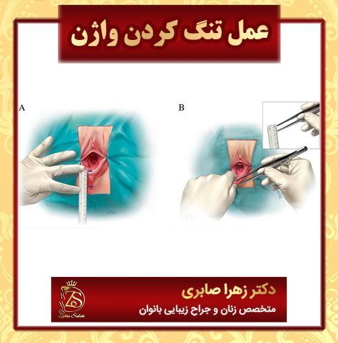 علل، علائم و درمان باز شدن بخیه پرینورافی | پیشگیری از مشکلات بخیههای پرینورافی