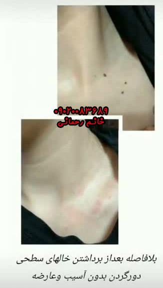 مراقبت بعد از برداشتن خال با محلول | ترمیم سریع و پوست بدون لک