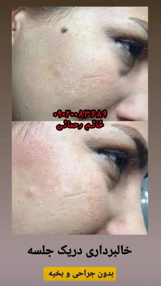 برداشتن خال گوشتی با محلول | راهکار طبیعی و موثر برای حذف خالهای پوستی