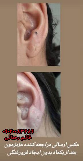 از بین بردن خال گوشتی بدون جراحی