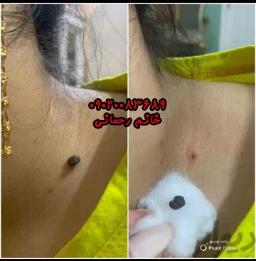 برداشتن خال با مواد گیاهی و محلول | راهکار طبیعی و موثر برای حذف خالهای پوستی